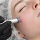 Laser Treatments